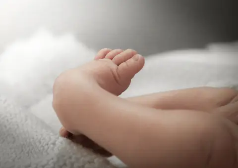 Clubfoot – Congenital Talipes Equinovarus (CTE)