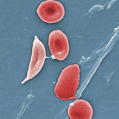 Sickle Cell Disease in the ED
