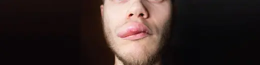 Angioedema