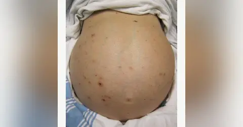 CORE IM podcast: Mind The Gap on Admission Paracentesis