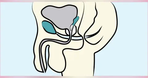 Vasectomy