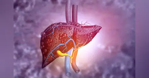 Liver Series – Liver Cirrhosis