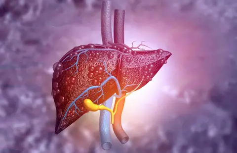Liver Series – Liver Cirrhosis