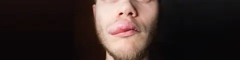Angioedema
