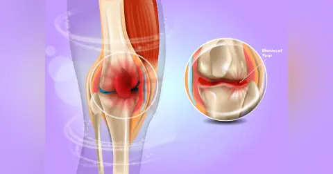 Meniscal Tears