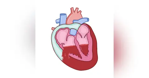 Cardiac Tamponade