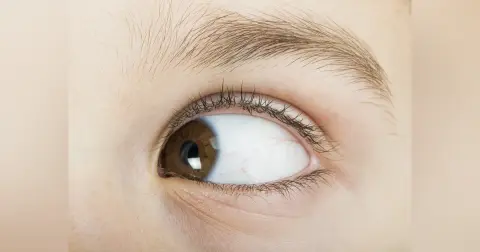 Strabismus