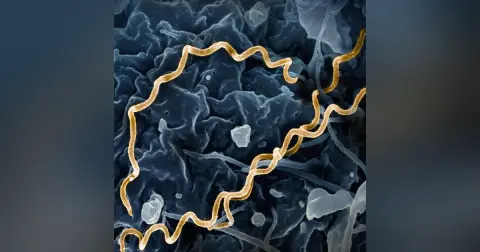 Syphilis: The Great Masquerader