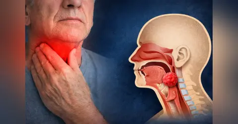 Laryngeal Cancer