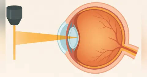 Laser Refractive Surgery