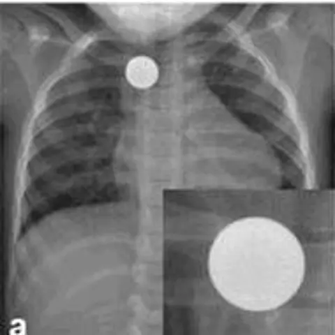 Button Battery Ingestion