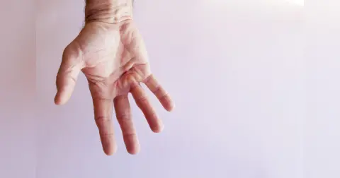 Dupuytren’s Contracture