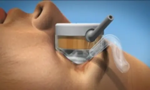 Ep 22 Talking About Glaucoma - 6Feb2014: HiFU Therapy (mp3 version)