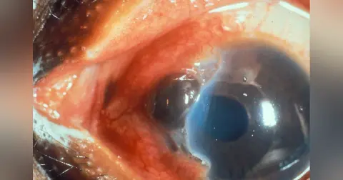 Ocular Trauma 2: Intraocular Foreign Bodies and Globe Rupture