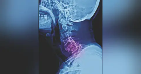 Episode 62 - Cervical Spine Injuries- An Interview with Dr. Jara-Alamonte