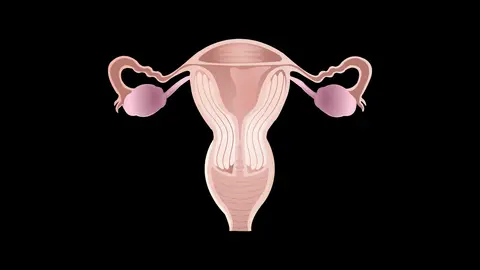 Endometriosis