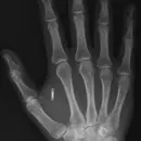 The Invisible Crime: Illegal Microchip Implants and Microwave Technology