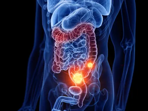 Colon Cancer Emergencies (Part 1)