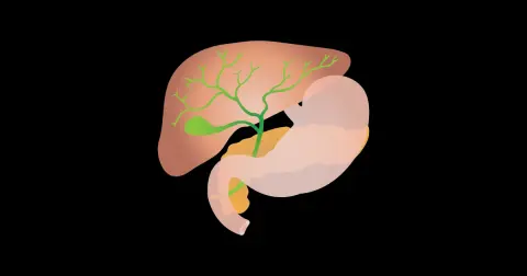 Laparoscopic Cholecystectomy
