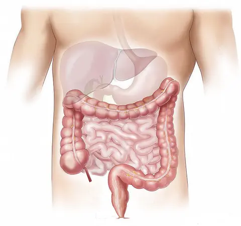 Acute Abdomen