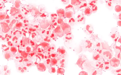 Conversation - Meningococcal Meningitis