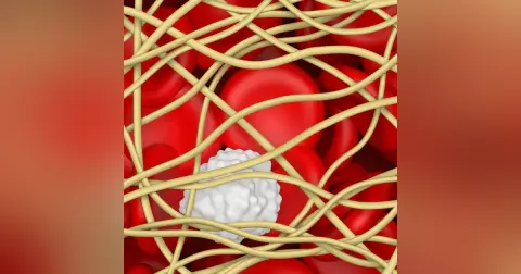 Pulmonary Embolism with Al Sacchettii, MD