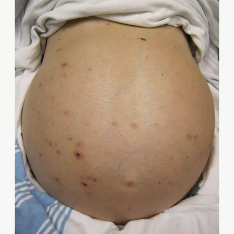 CORE IM podcast: Mind The Gap on Admission Paracentesis