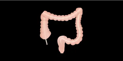 Complications of Segmental Colectomy