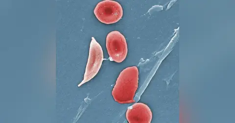 Sickle Cell Disease in the ED