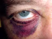 Orbital Fracture
