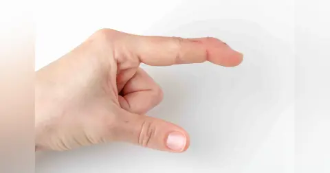 Mallet Finger