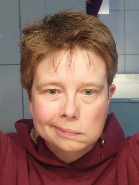 Facial Nerve Palsy Part 2