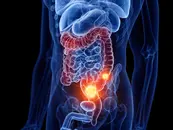 Colon Cancer Emergencies (Part 3)