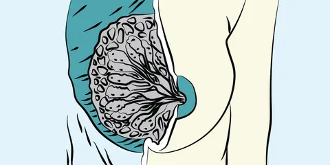 Approach to Breast Lumps