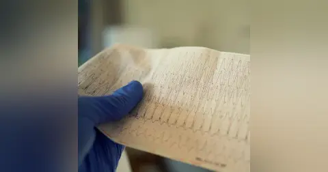 Wide Complex Tachycardia