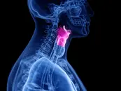 Vocal Fold Paralysis