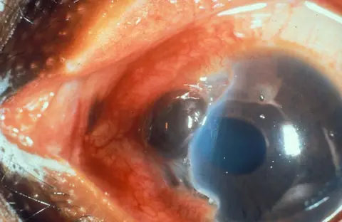 Ocular Trauma 2: Intraocular Foreign Bodies and Globe Rupture