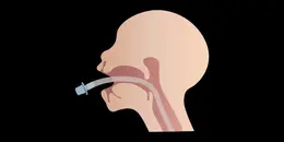 The Difficult Airway