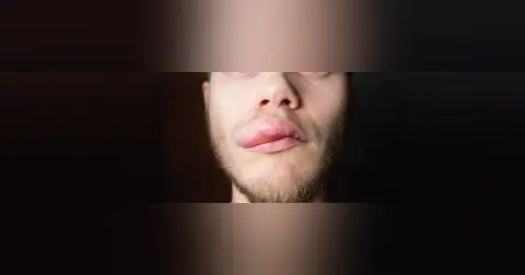 Angioedema