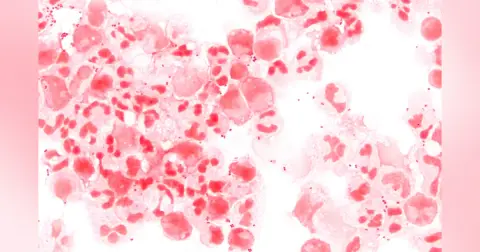 Conversation - Meningococcal Meningitis