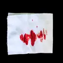 Rectal Bleeding