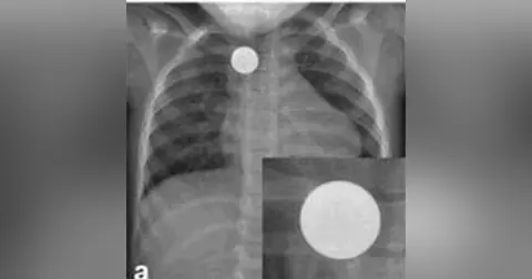 Button Battery Ingestion