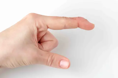 Mallet Finger