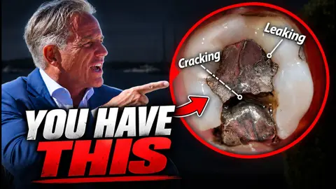 Exposing the Truth About Mercury Fillings (And What Your Dentist Won’t Tell You)