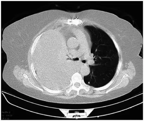 Journal Club: Small-bore vs Large-bore Chest Tube for Hemothorax