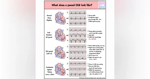 #140 Bonus Pacemaker & ICDs: 5 Pearls Segment