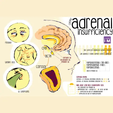 #13 Chronic Adrenal Insufficiency: 5 Pearls segment