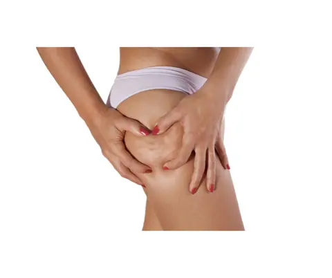 What Actually Causes Cellulite? A Cosmetic Chemist and Esthetician Explain the Science Behind Treatments