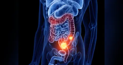 Colon Cancer Emergencies (Part 3)