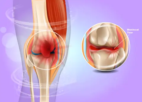 Meniscal Tears